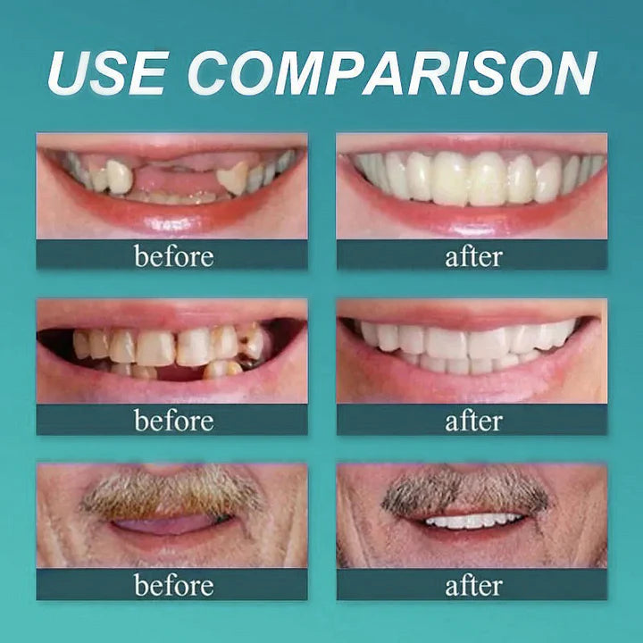 š Acezozla⢠Custom-Fit Dentures ā° ENDS TODAY 70% OFF | Smile with Confidence