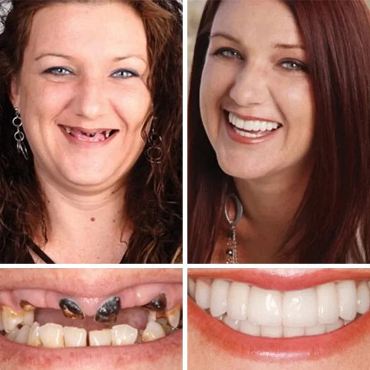 🌎 Acezozla™ Custom-Fit Dentures ⏰ ENDS TODAY  70% OFF | Smile with Confidence