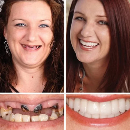 🌎 Acezozla™ Custom-Fit Dentures ⏰ ENDS TODAY  70% OFF | Smile with Confidence